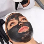 Carbon Laser Peel